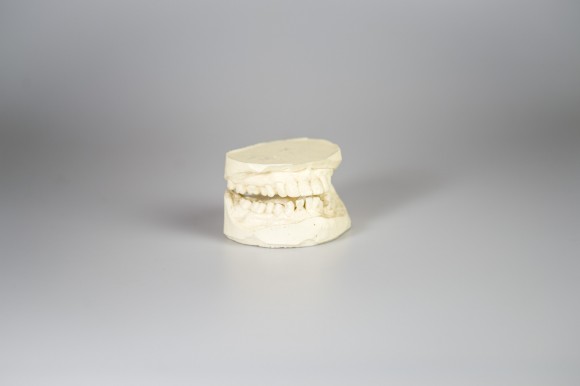 Cast Plastic Teeth